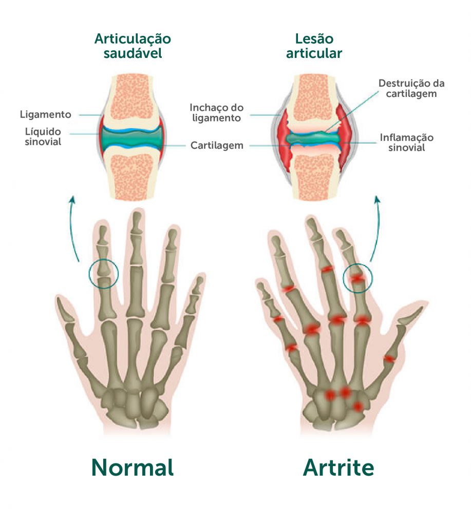 artrite e artrose