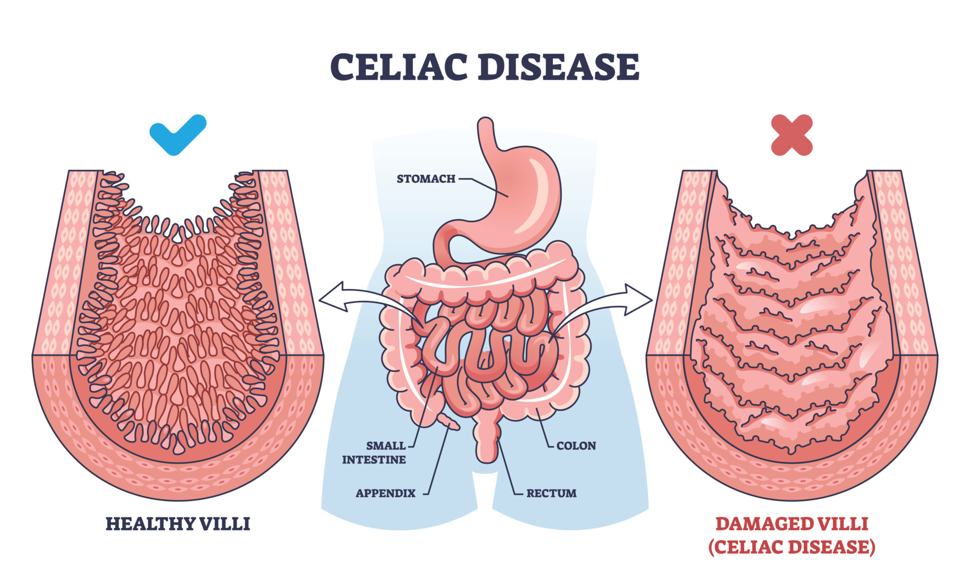 A imagem mostra uma ilustração onde é possível ver à esquerda um intestino delgado saudável com a seu revestimento livre de inflamações. Já na imagem à direita, vemos a representação de um intestino delgado de um paciente celíaco, com o seu revestimento inflamado e sem definições