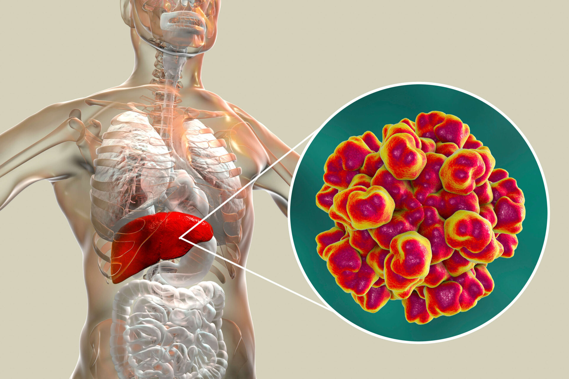 Hepatite viral: o que é, quais os tipos mais comuns e prevenção por meio da alimentação